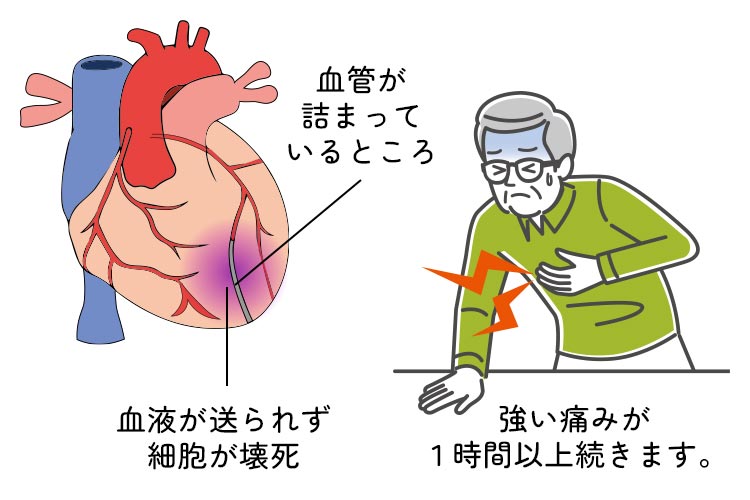 心筋梗塞