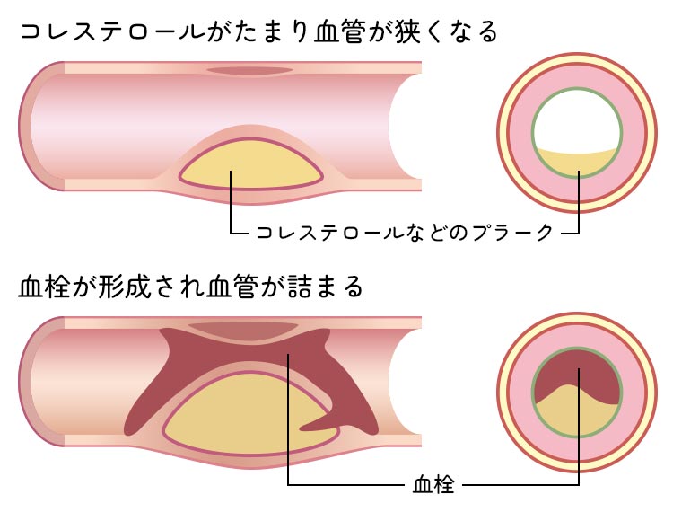 コレステロール異常は何が悪いの？ image44